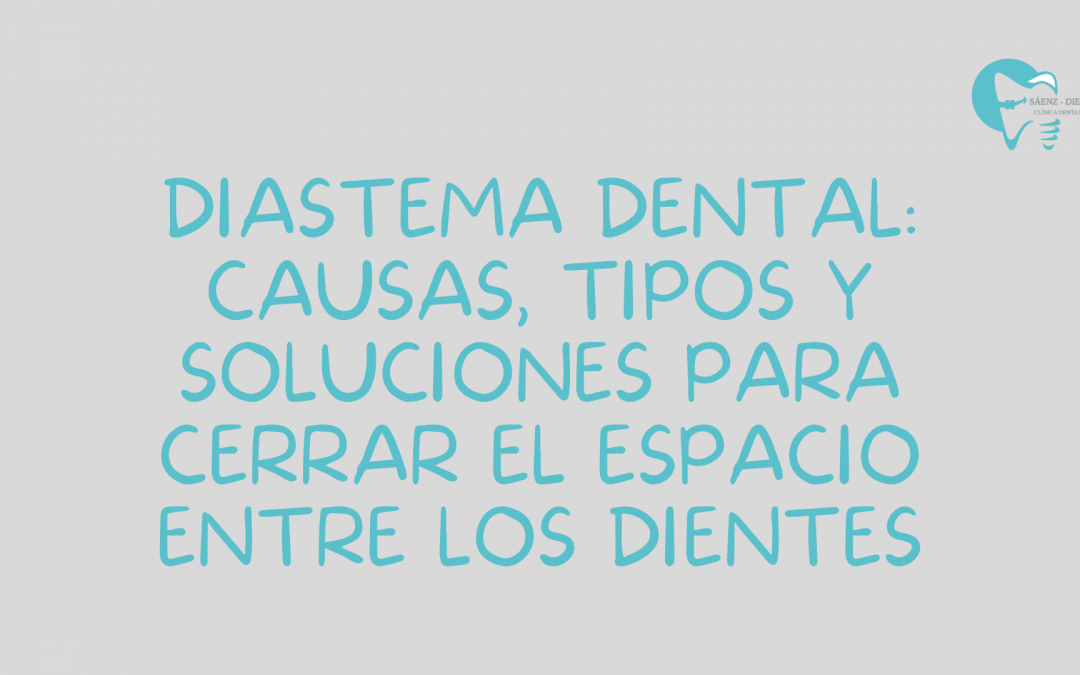 Diastema dental: causas, tipos y soluciones para cerrar el espacio entre los dientes