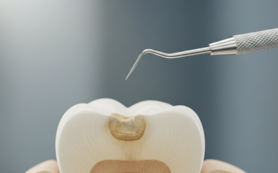 Odontología mínimamente invasiva: ¿Qué es y por qué importa?